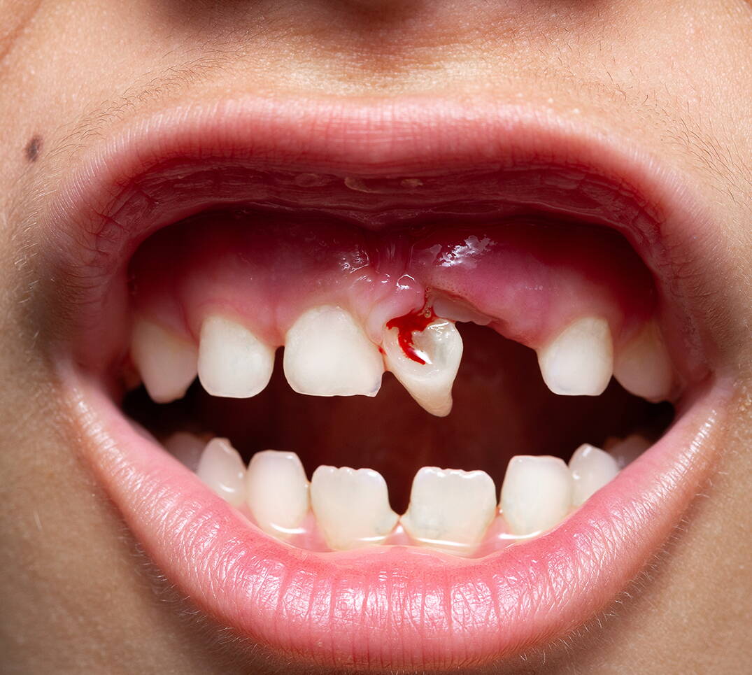 Primo piano di una bocca con un dente mancante e tracce di sangue. Un dente espulso deve essere curato rapidamente per evitare danni consequenziali.
