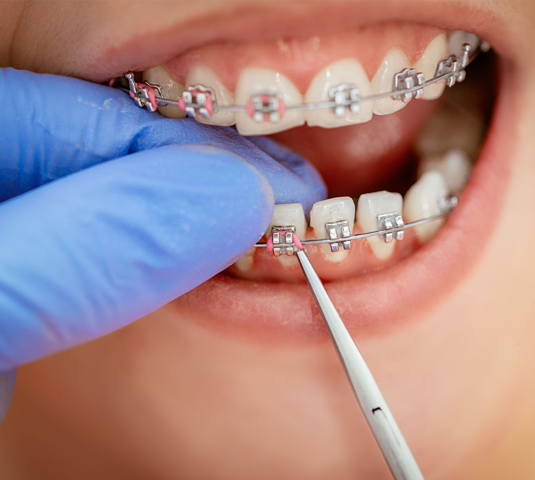 Nahaufnahme einer Zahnspangenbehandlung: Kieferorthopäde mit Latexhandschuhen passt Brackets mit Instrument an